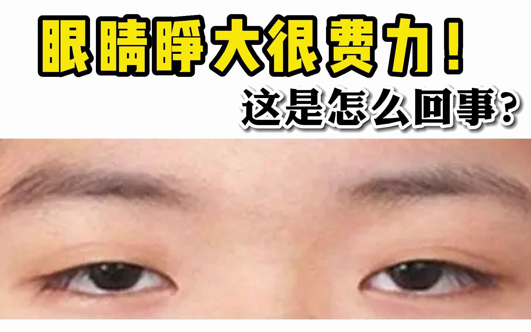 眼睛睁大很费力，睁不开眼！这是怎么回事？
