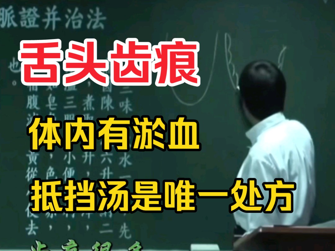 舌头齿痕代表体内有淤血，去淤血唯一处方抵挡汤。