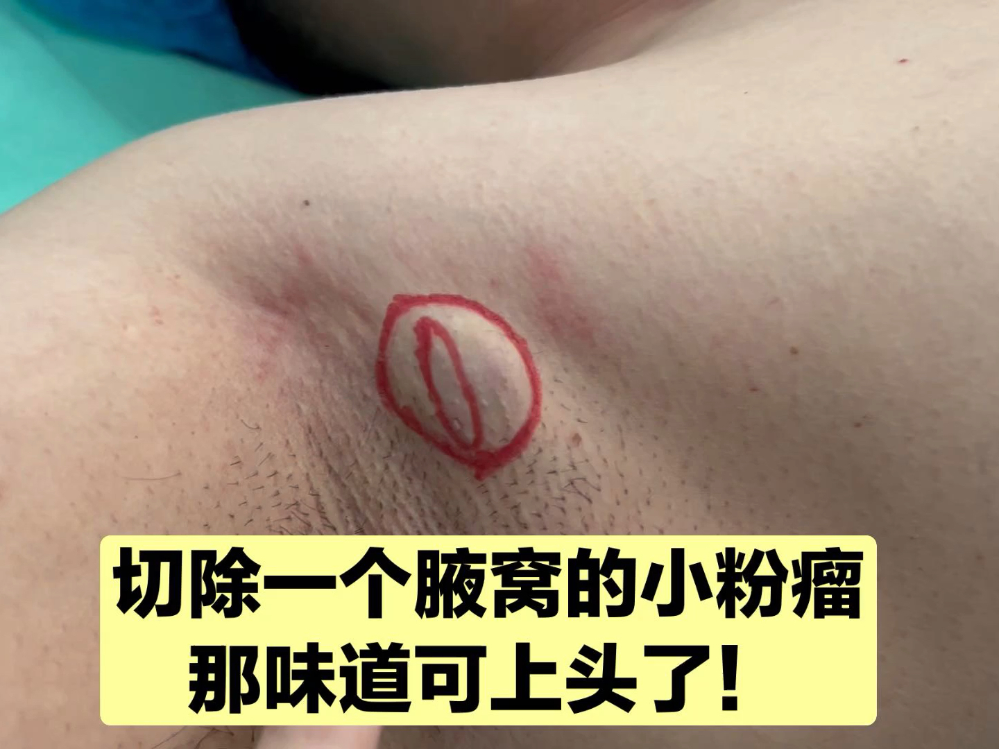 皮下肿物开盲盒，东西不大，味道却很上头！医生挤出来真解压！