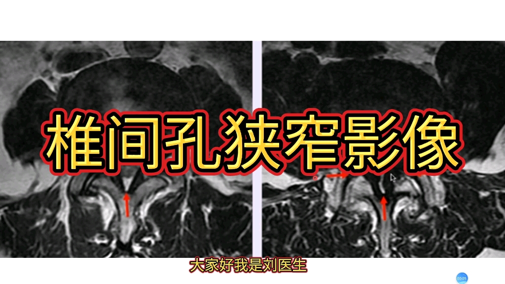 椎间孔及中央椎管狭窄MRI如何诊断？病例分享！