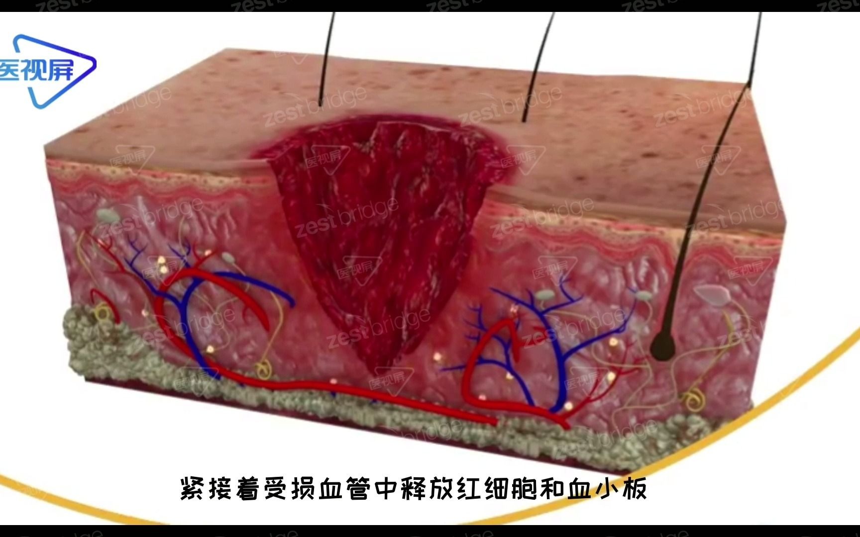 3D还原：伤口愈合全过程