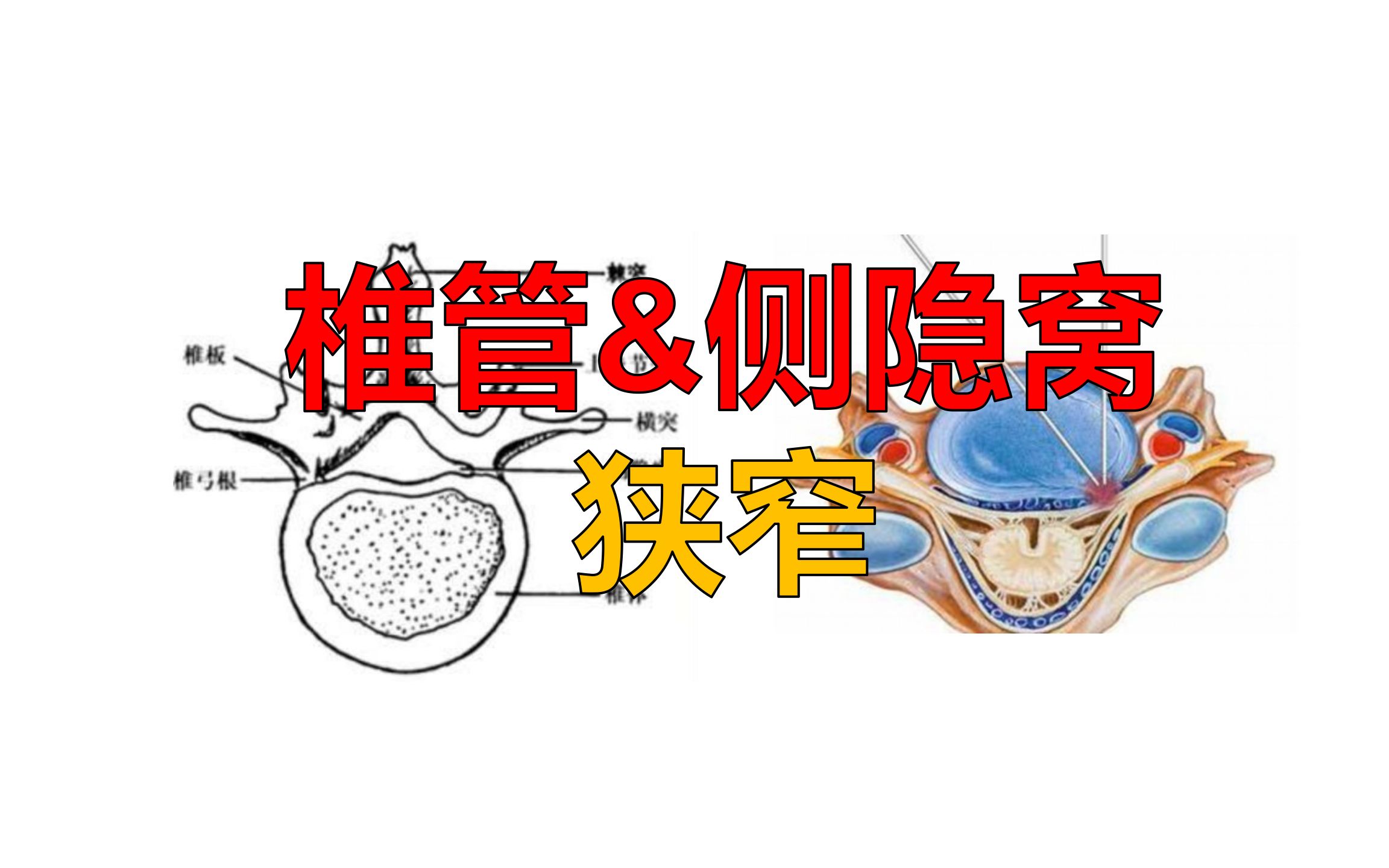 椎间盘突出的两种类型：椎管狭窄与侧隐窝狭窄