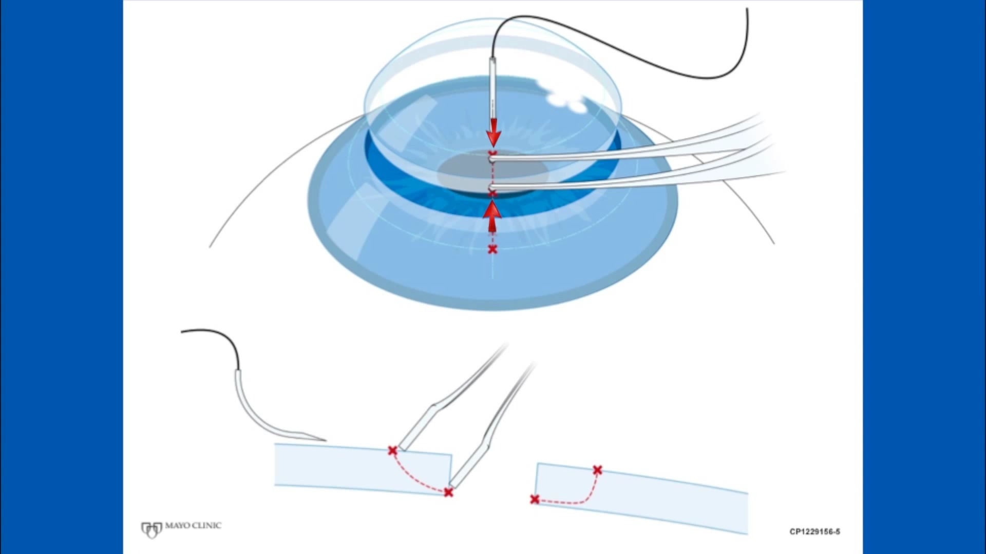 63-Corneal Suturing, Part 2 - Placing the Needle Into the Graft 角膜缝合