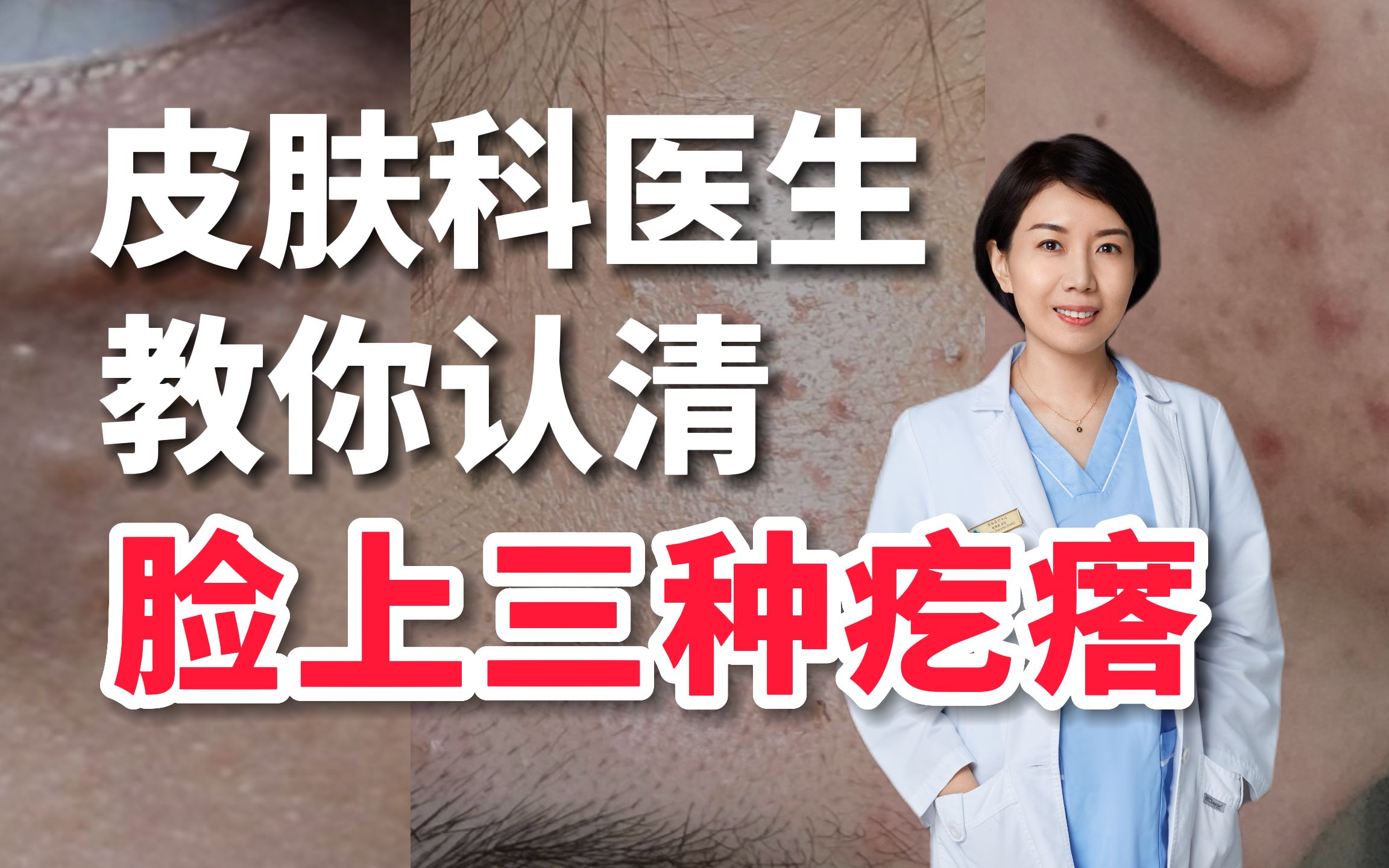 【科普】脸上的这三种小疙瘩，对症下药有效处理！