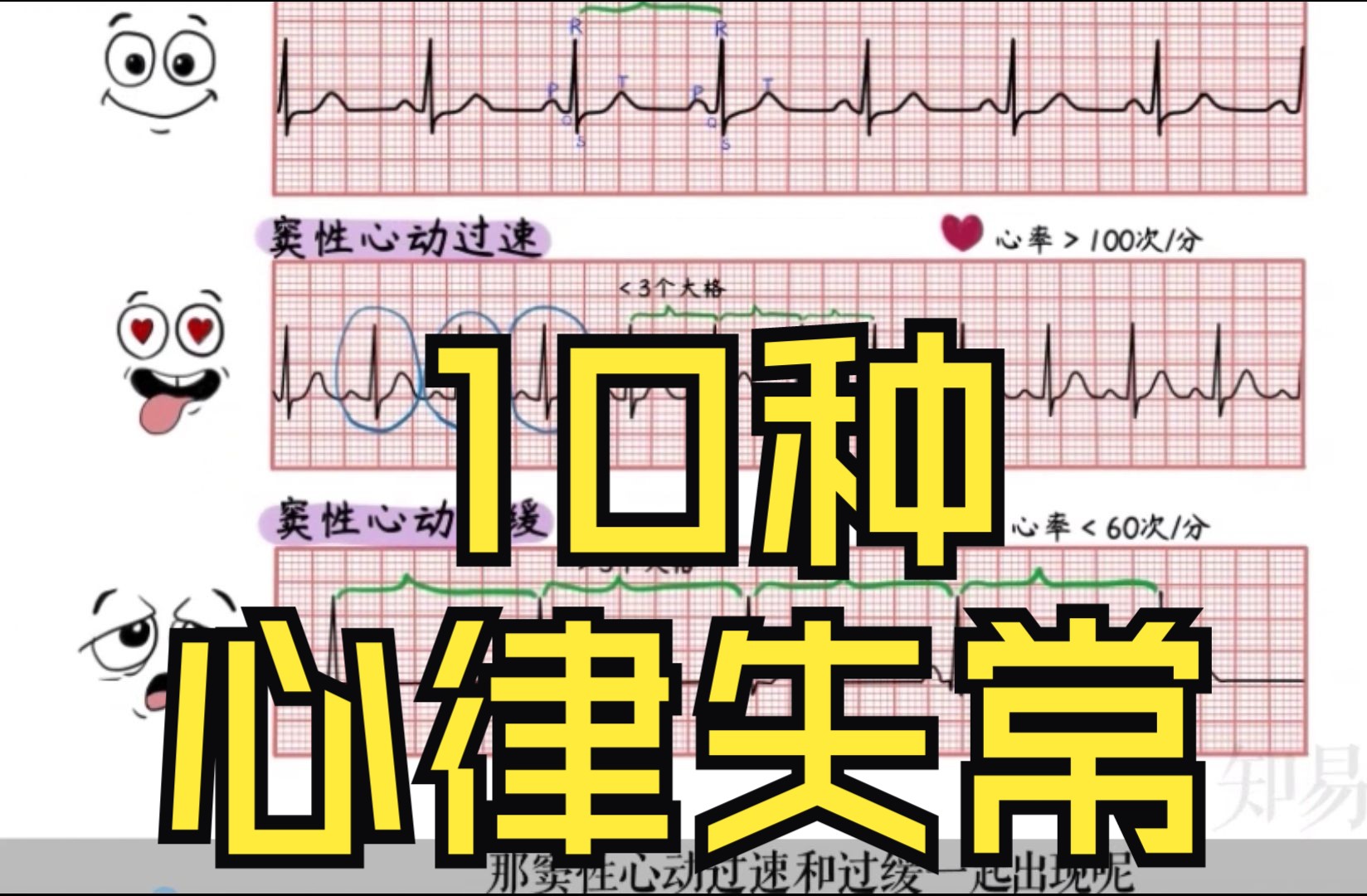 手绘精讲【心律失常】|常见10种心律失常心电图