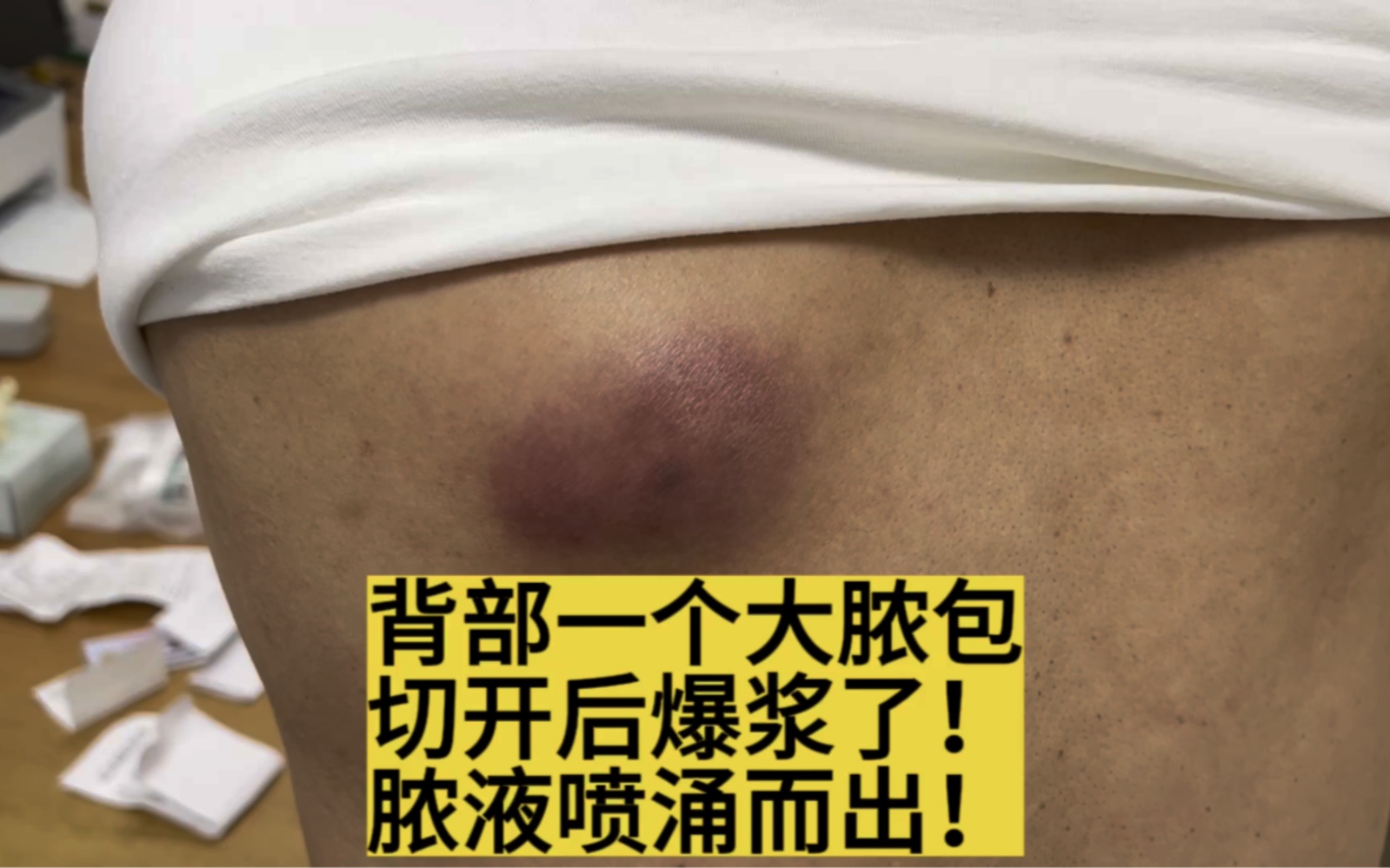 脓腔压力太大，一切开就喷射了，差点喷医生一身！