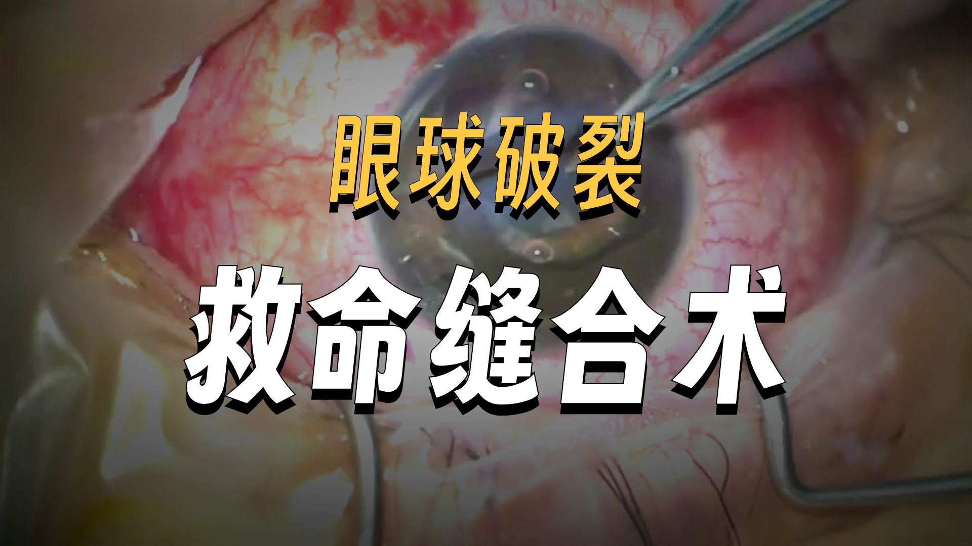 26-CataractCoach 1413 ruptured globe repair  corneal laceration