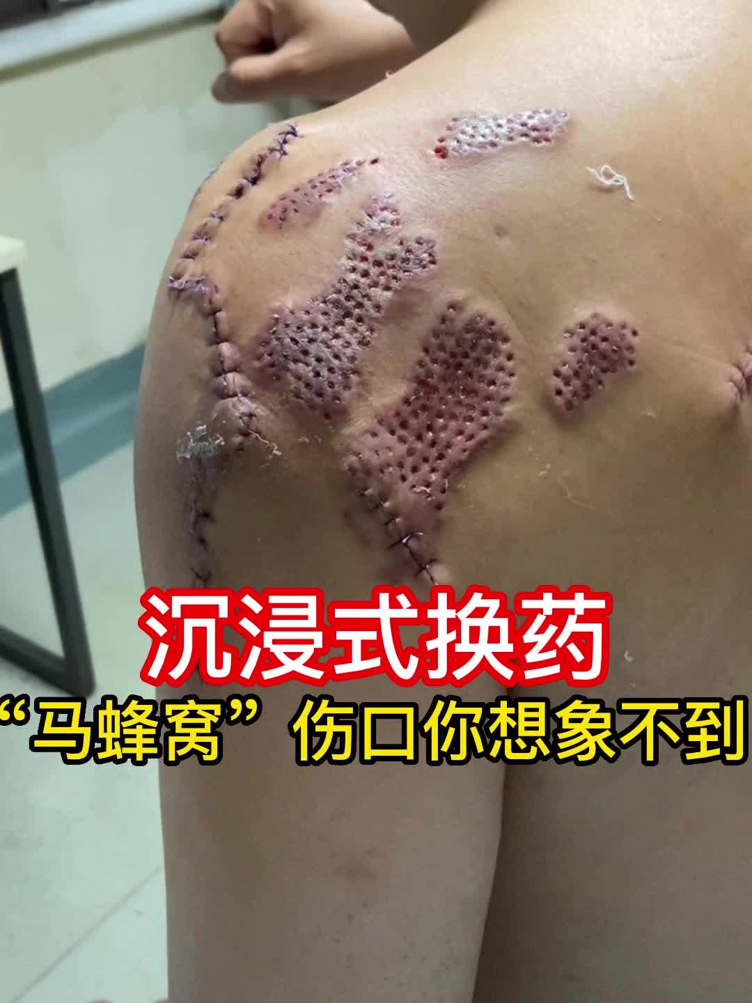 沉浸式换药，大哥笑称今天第一个进来没排队