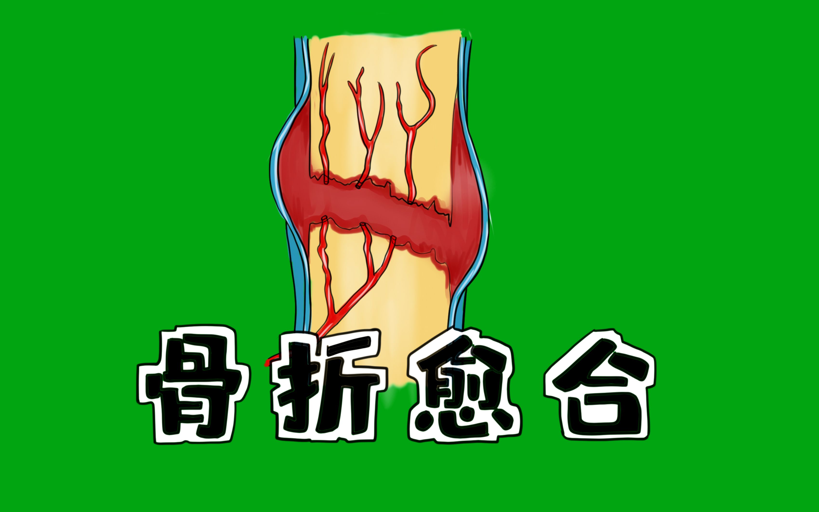 医学手绘精讲 | 骨折愈合过程