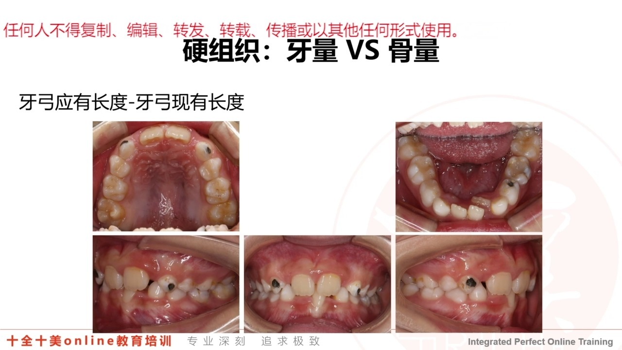十全十美第三期早期矫治系列