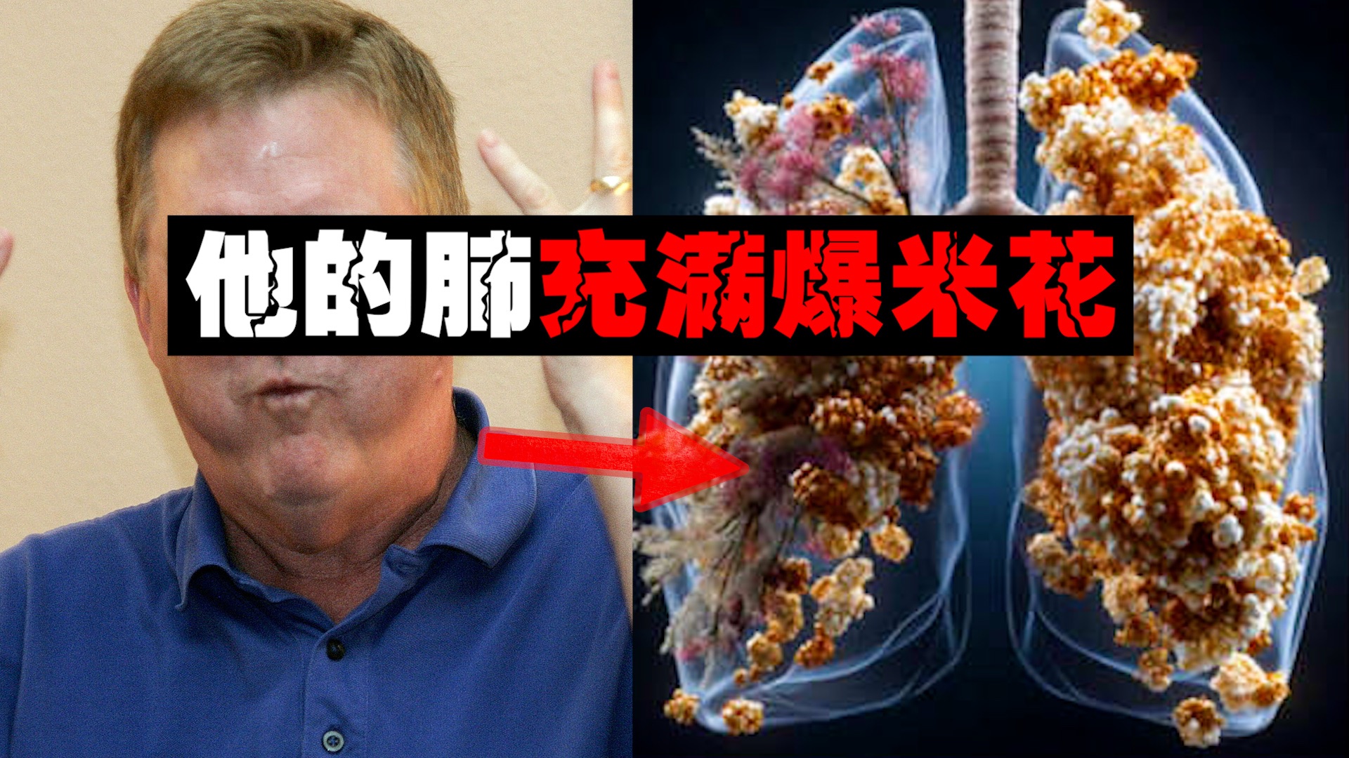 【爆米花肺】男子连续吃8千袋爆米花后，他的肺要爆了。。。。