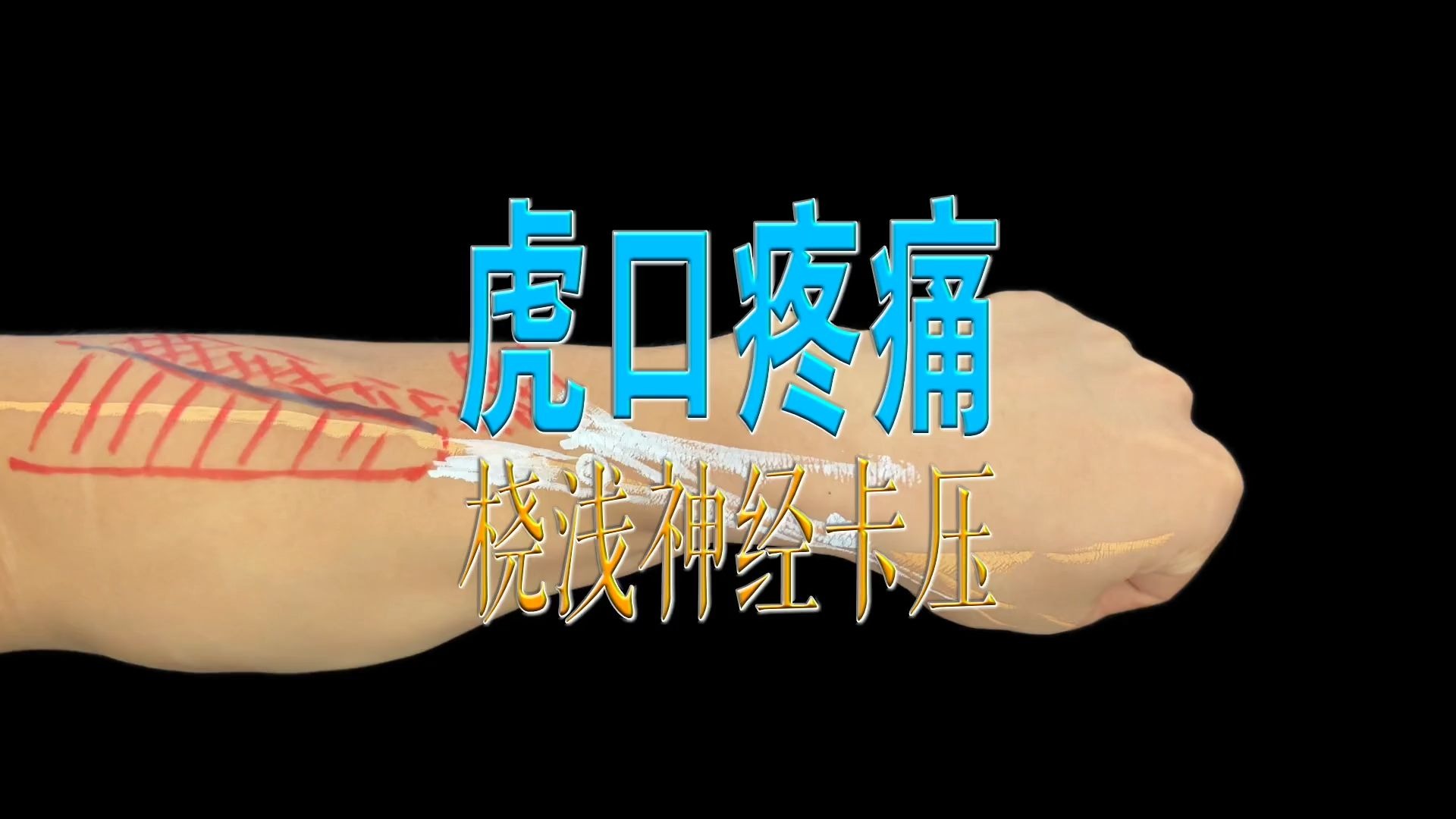 虎口疼痛
