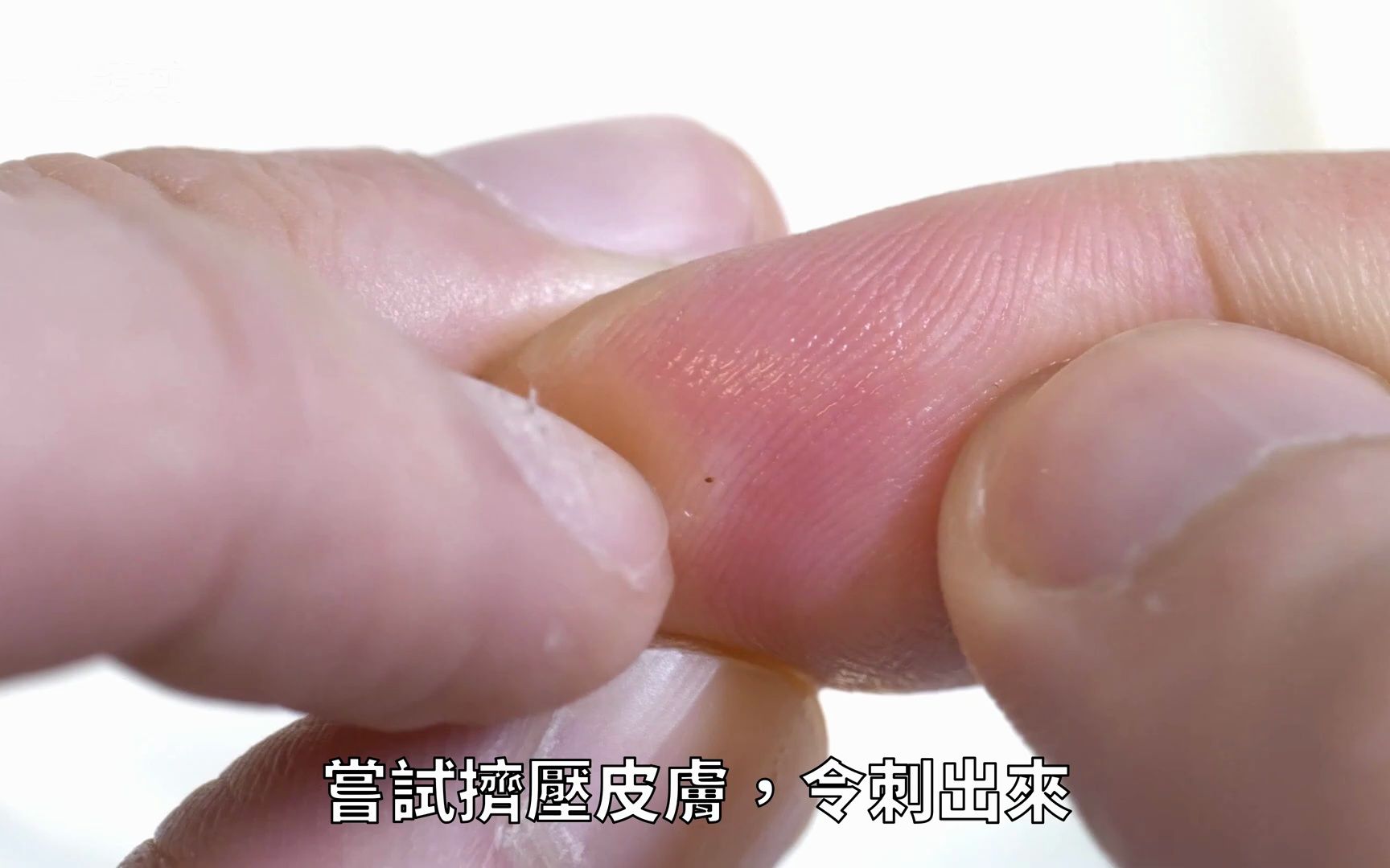 手指扎到刺了拔不出來，怎么办？3个教你的拔刺小妙招！