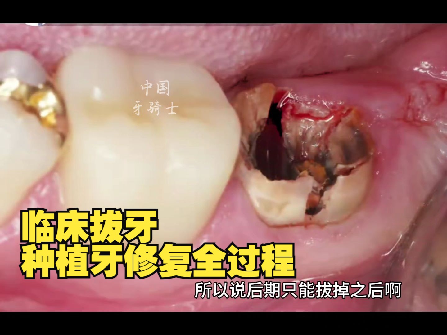 医生第一视角，临床拔牙、种植牙修复全过程