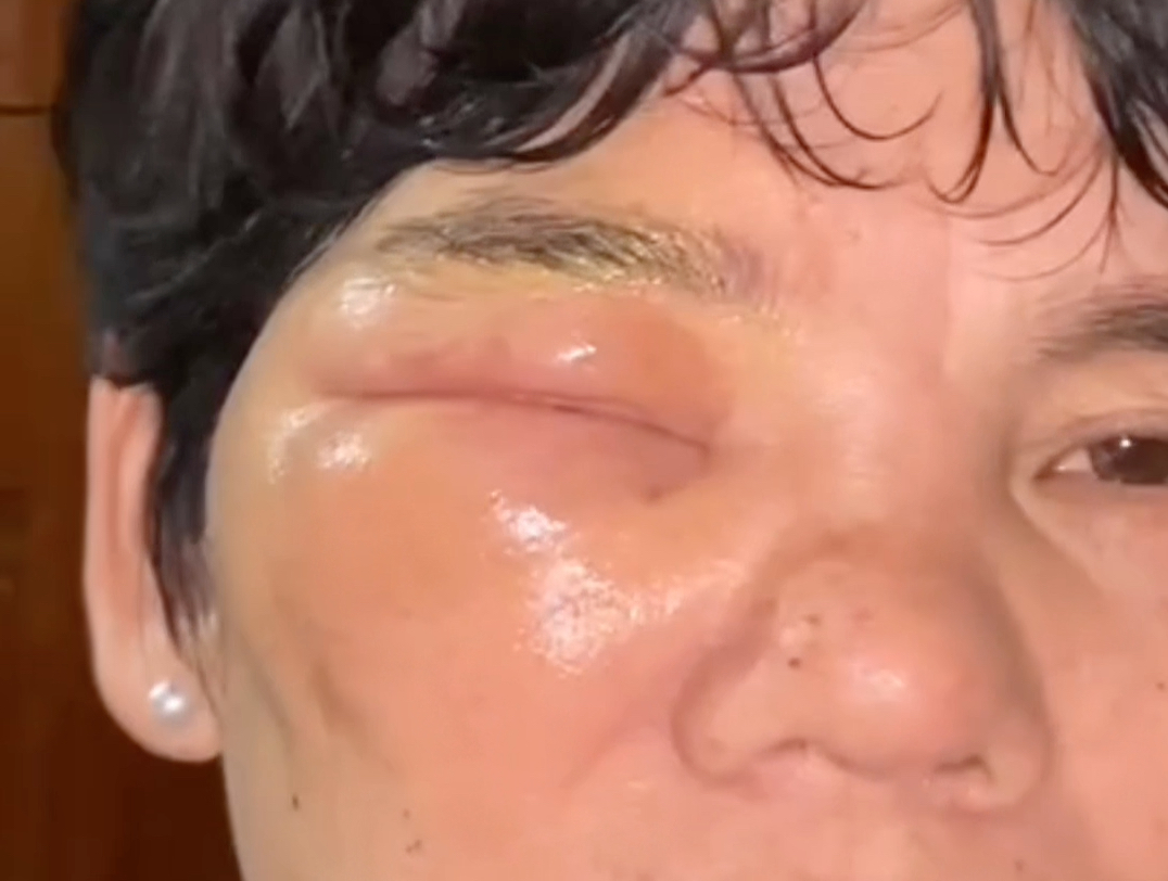 我妈被虎头蜂蛰了，肿的儿子都认不出来了……