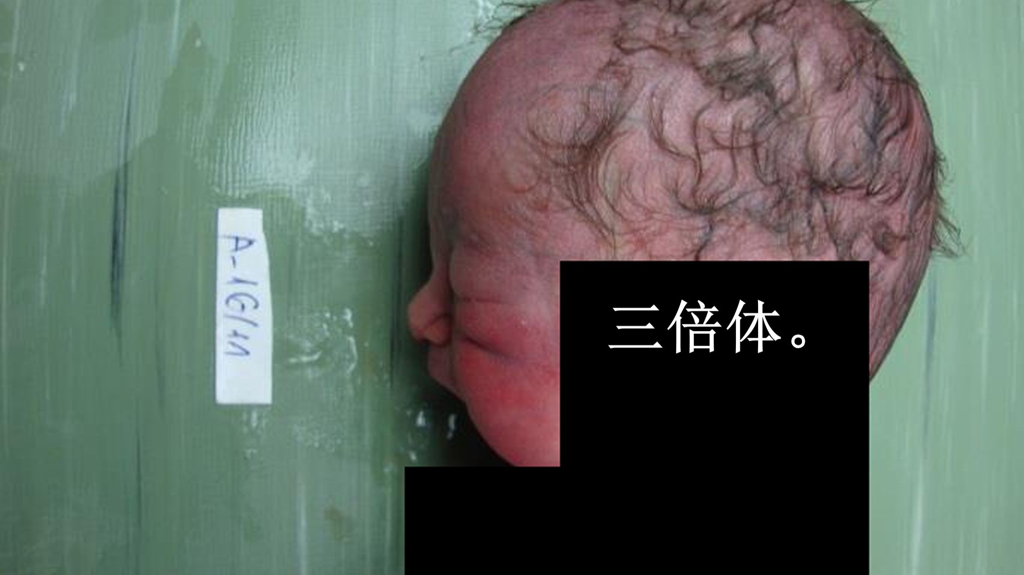 以为18号染色体多了一条，结果是全部染色体都多了一条。